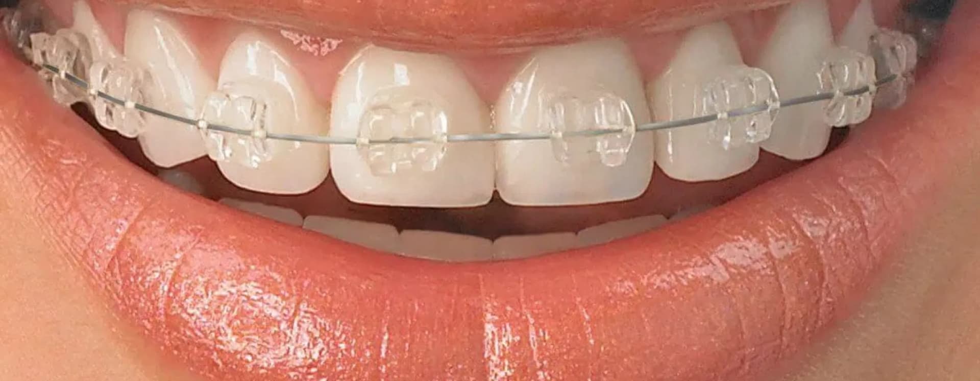 /braces-aligners/ceramic-braces.webp