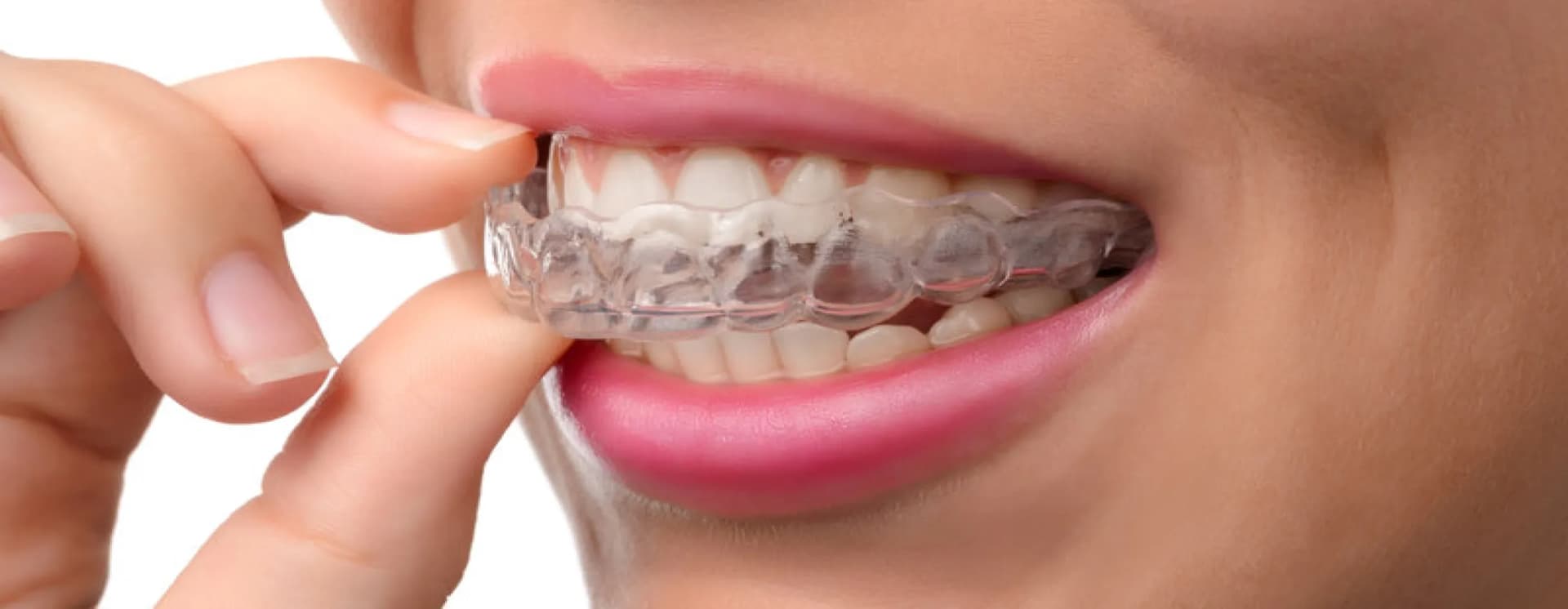 /braces-aligners/clear-aligner.webp