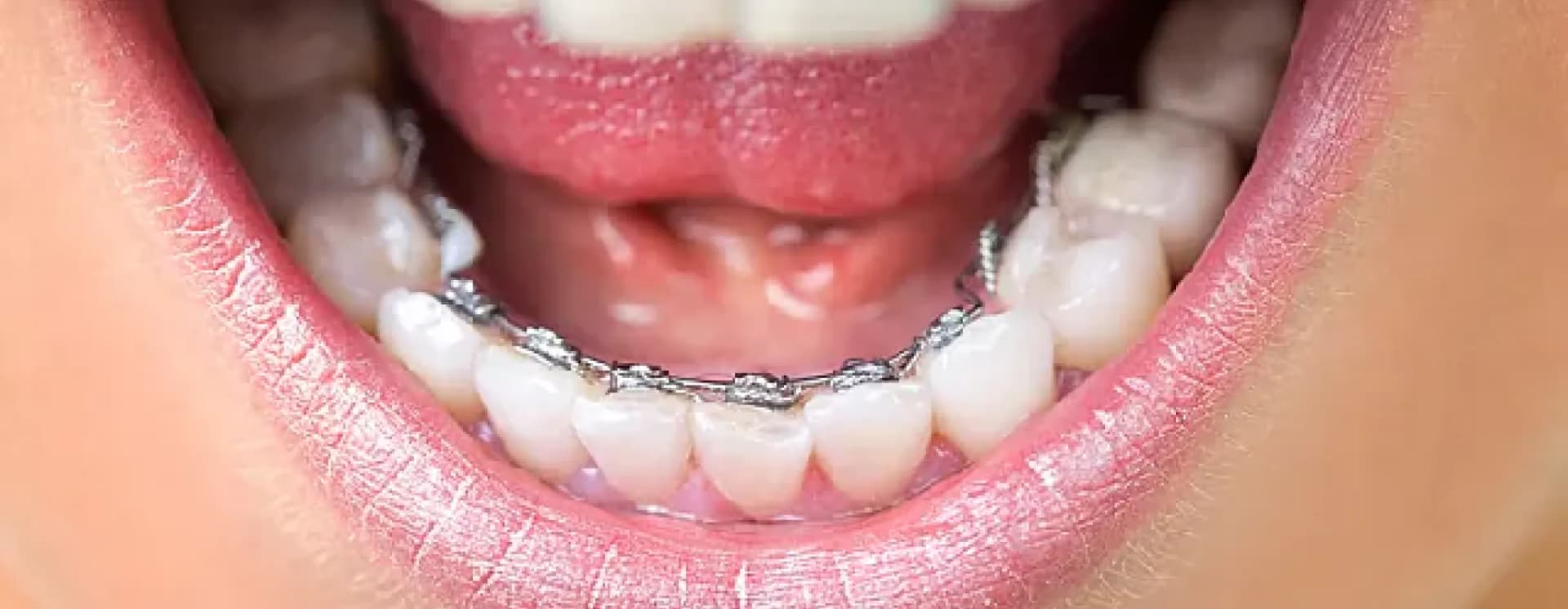 /braces-aligners/lingual-braces.webp