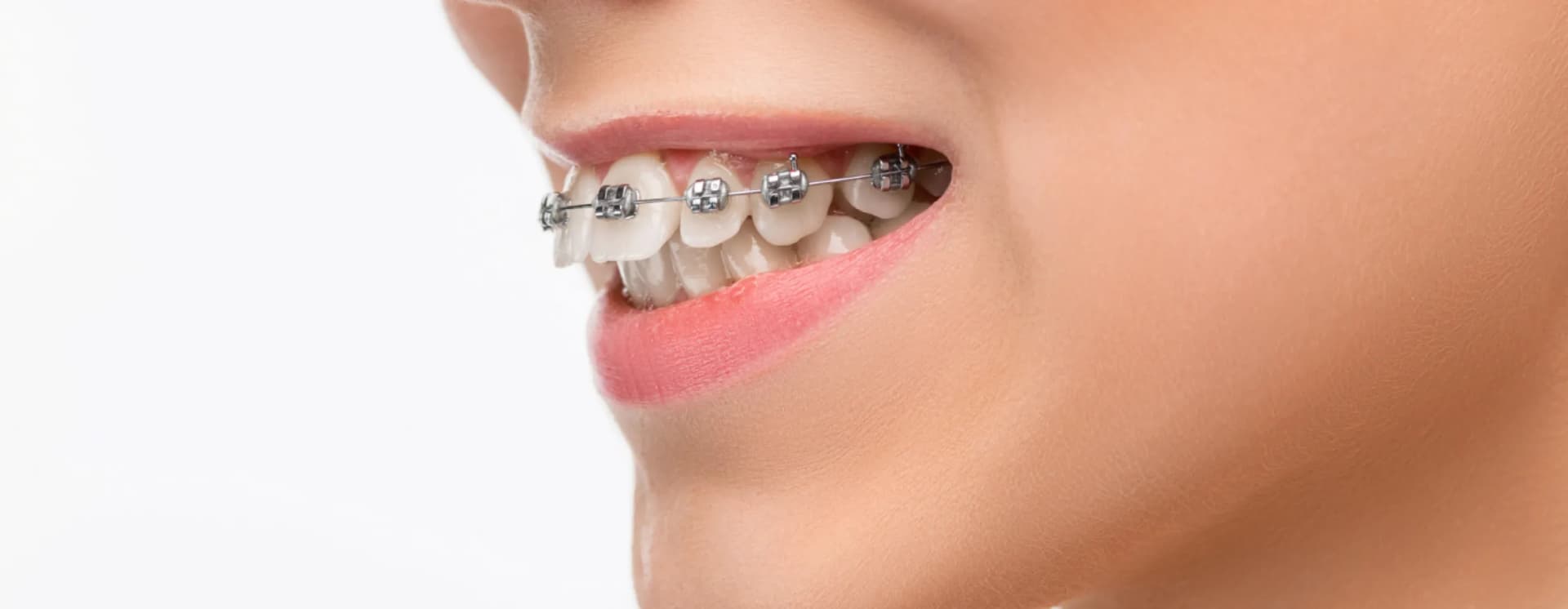 /braces-aligners/metal-brace.webp