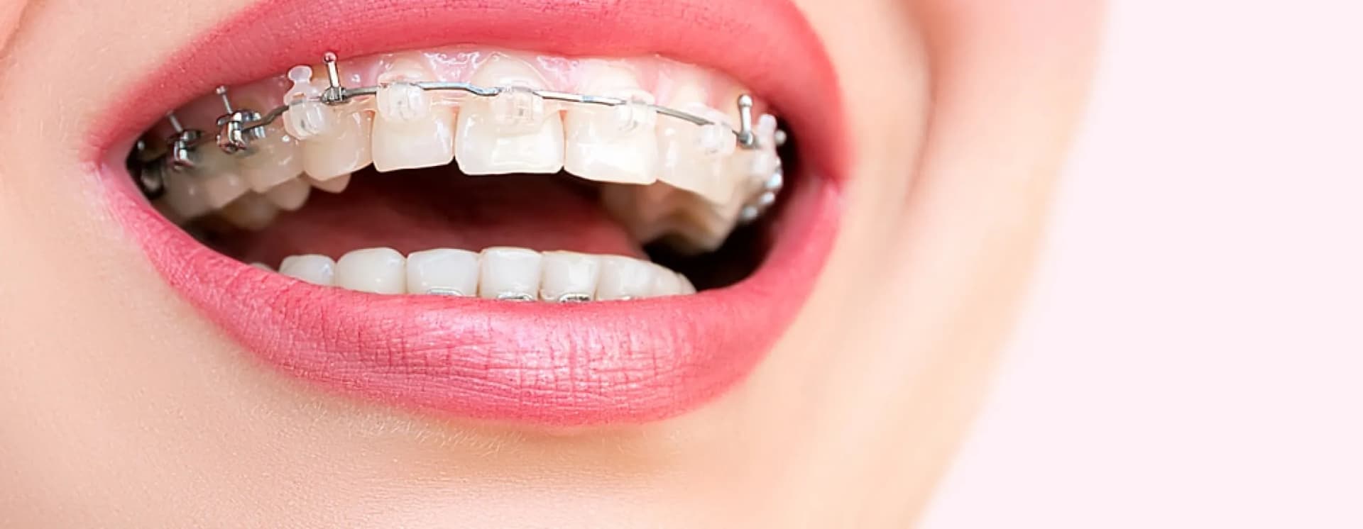 /braces-aligners/self-ligating-braces.webp