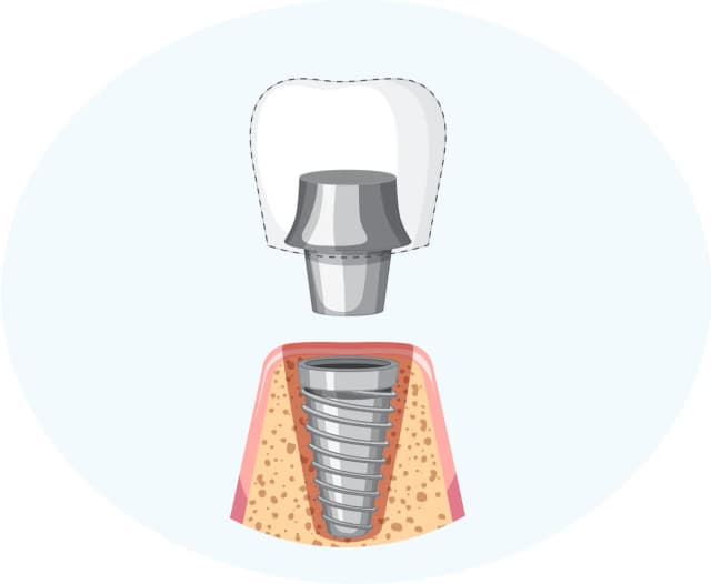 /dental-implant/fifth-img.webp