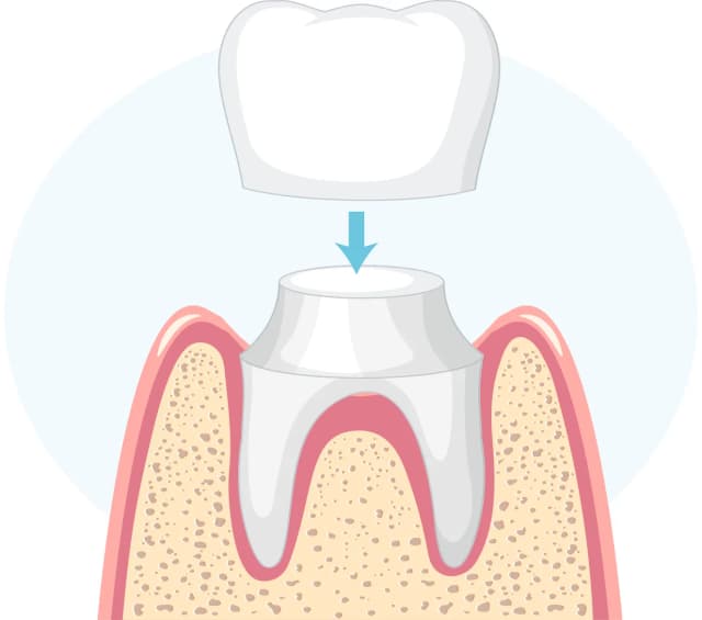 /dental-implant/seventh-img.webp