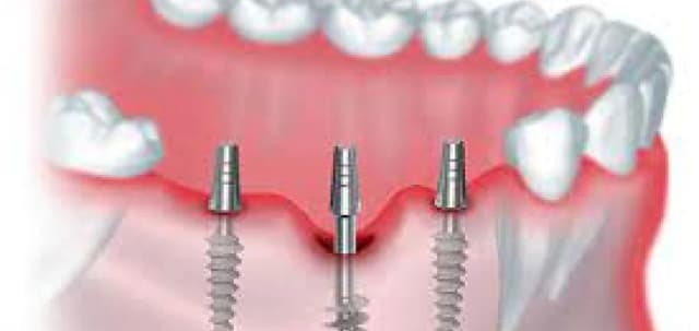 basal-implant-img