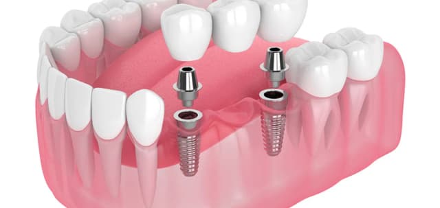 multi-teeth-implant-img