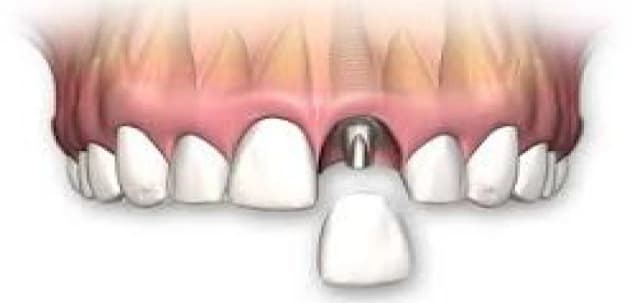 single-teeth-implant-img