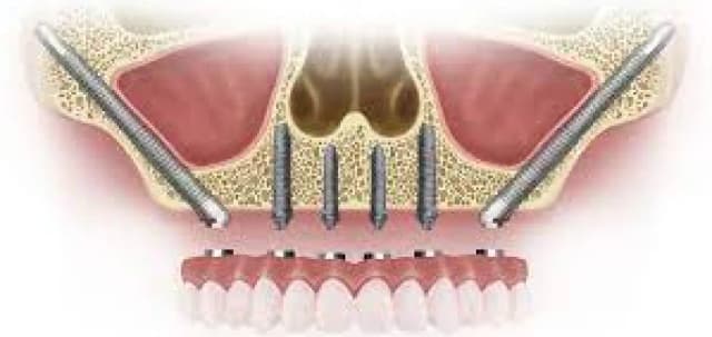 zygomatic-implant-img